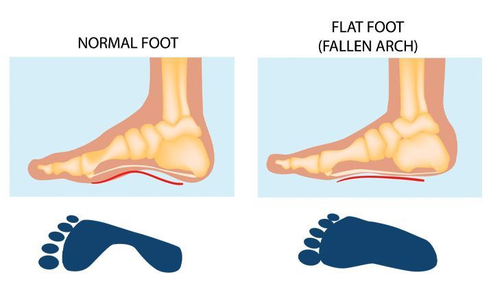 The Flat Feet Diaries